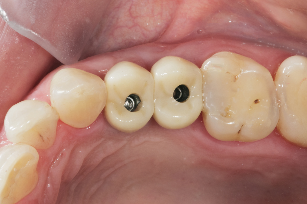 Screw-retained implant crowns