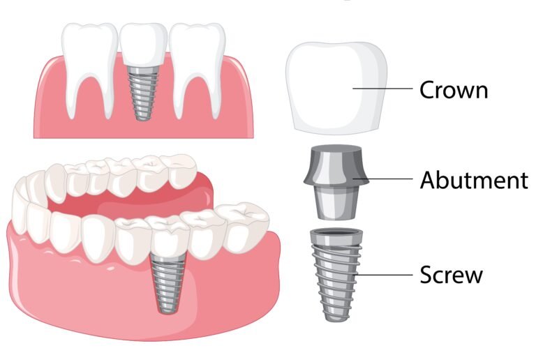 Custom Abutment and Screw Retained Implant Crown