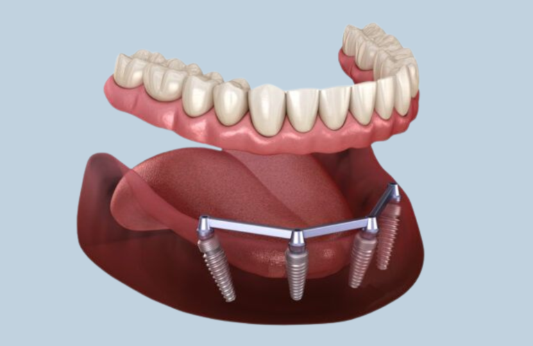 All-on-4 Temporary vs. Permanent Dental Implants Solutions