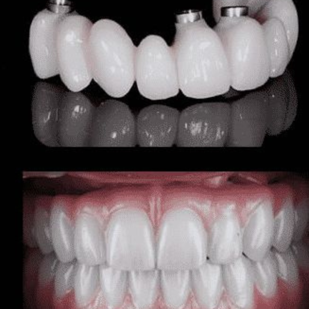 Before and After of All on 4 Dental Implant - Uptown Dental Lab