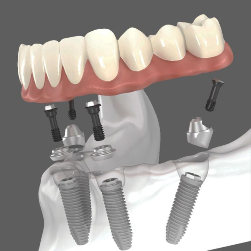 All on 4 Dental Implant Process - Uptown Dental Lab