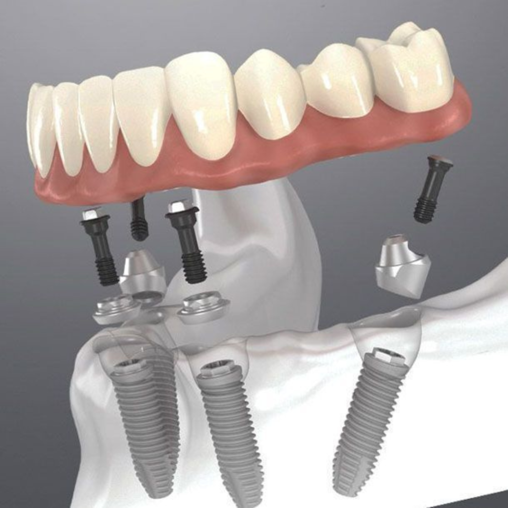 Zirconia Material for Dental Implant