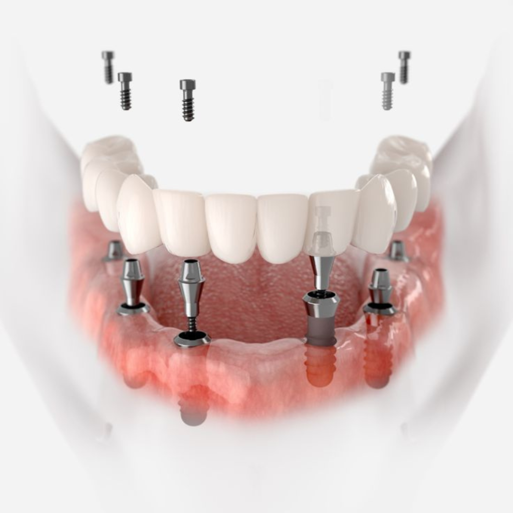 PMMA Material for Dental Implant