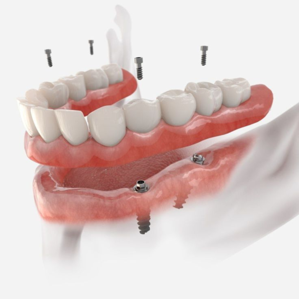 Acrylic Material for Dental Implant