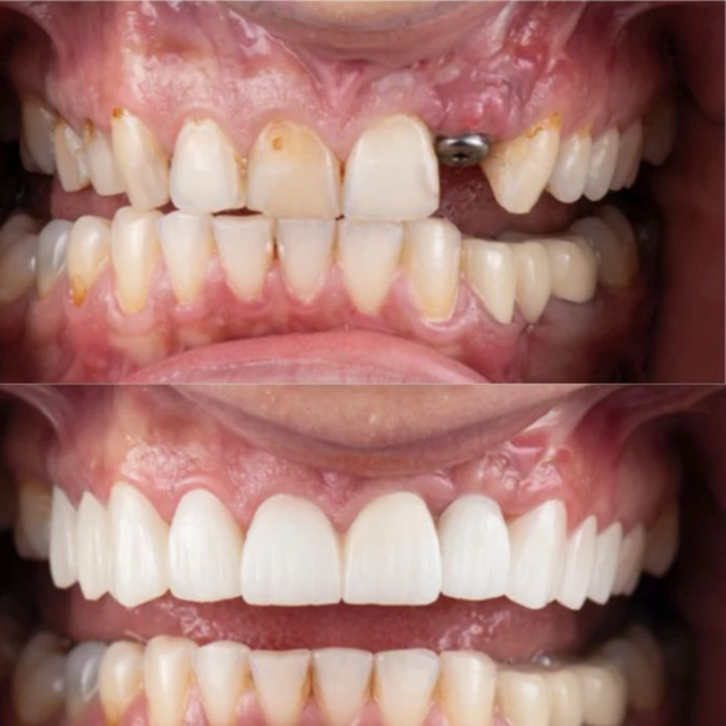 Before and After Permanent Crowns - Uptown Dental Lab